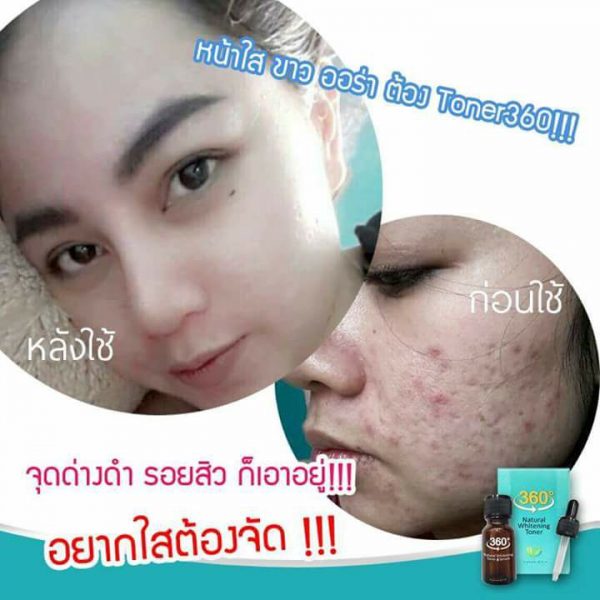 360 Natural Whitening Toner Serum - Toner for Melasma - Image 4