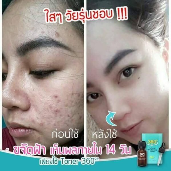 360 Natural Whitening Toner Serum - Toner for Melasma - Image 5