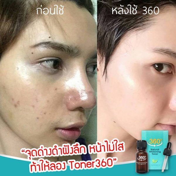 360 Natural Whitening Toner Serum - Toner for Melasma - Image 6