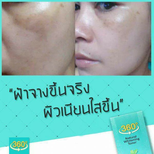 360 Natural Whitening Toner Serum - Toner for Melasma - Image 8